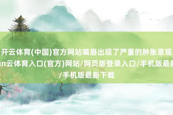 开云体育(中国)官方网站嘴唇出现了严重的肿胀景观-开yun云体育入口(官方)网站/网页版登录入口/手机版最新下载